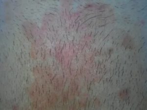 Зуд и шелушение на лобке и голене