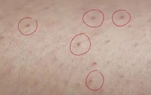 Темные пятна от вросших волос