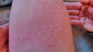 Красный дермографизм, зуд кожи