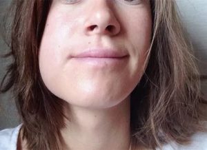 Опухлость щеки, синяк после пломбирования зуба