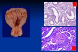 Прогрессирующая гиперплазия эндометрия