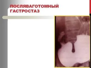 Гастростаз