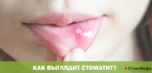 Увеличивающияся язвочка