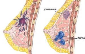 Уплотнение в груди у девочки 9 лет