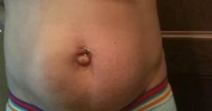 Слева от пупка ноющее уплотнение