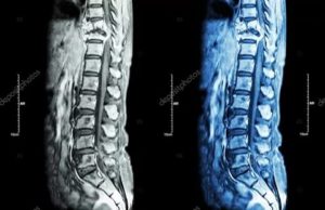 Метастазы в шейном отделе позвоночника? Или все-таки нет?