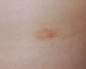 Пятна на теле которые меняют цвет и не передаются