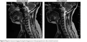 Метастазы в шейном отделе позвоночника? Или все-таки нет?