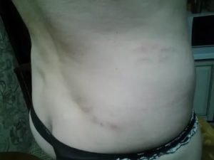 Сыпь на спине, боль в боку