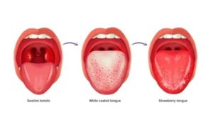 Тёмный налёт на языке ангина насморк