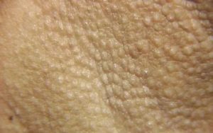 Пигментация на половой губе