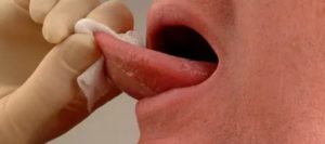 Наросты на бахромчатых складках языка