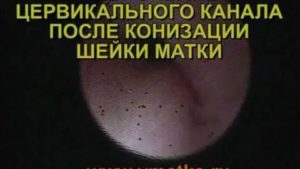 Месячные после конизации шейки матки