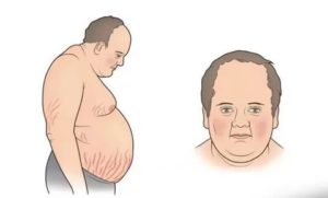 Синдром Иценко Кушинга