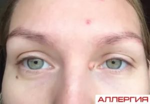 Аллергия на краску для бровей