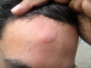 Красная шишка на лбу