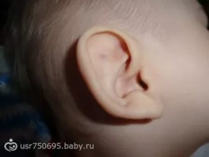 Пятно на ухе у ребёнка