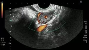 Жёлтое тело 27 мм на 20 день цикла