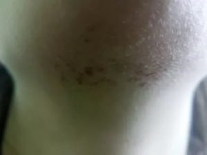 Пятно на подбородке