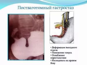 Гастростаз