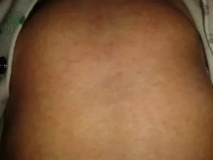 Сыпь на груди животе и спине