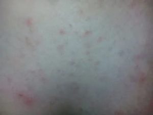 Появились симметричные прыщи по телу