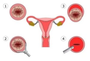 Месячные после конизации шейки матки