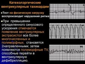 Ортостатическая тахикардия