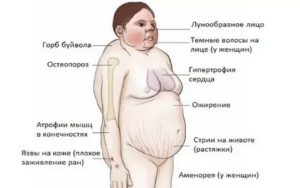 Синдром Иценко Кушинга