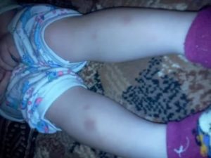 Синяки на ногах у ребенка