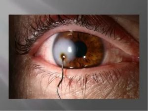 Кот поцарапал глазное яблоко