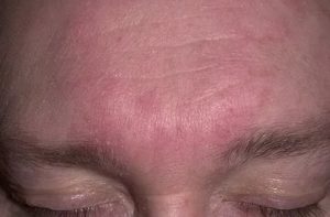 Шелушение на лбу