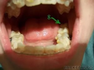 После удаления 8 ки