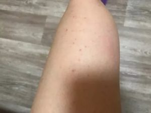 Прыщи на бицепсе переходят на руки ниже