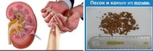 Песок в почках и температура 37/5