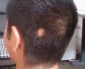 Облысение на затылке