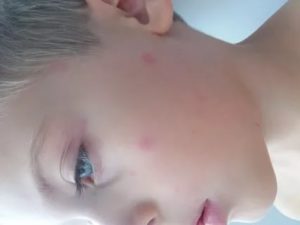 Сыпь и зуд до крови у ребенка