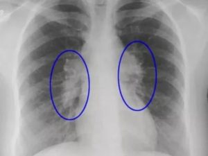 На рентгене выявлены изменения в легких