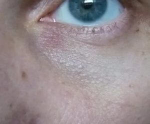Красное пятно на нижнем веке