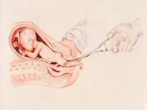 Беременность через месяц после аборта