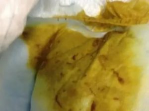 Кал грудничка пахнет уксусом