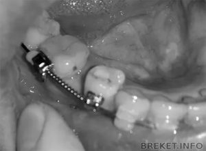 После удаления 8 ки