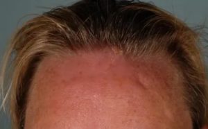 Красная шишка на лбу