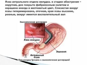 Острая язва антрального отдела желудка