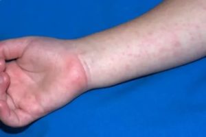 Аллергия с волдырем на метронидазол