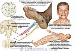 Риск заражения столбняком дома