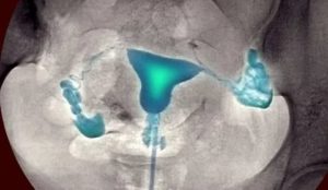 Проходимость маточных труб