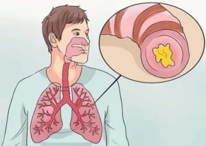 Камни в дыхательных путях