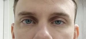 Одно веко ниже другого