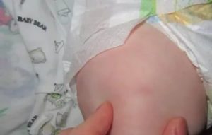 Уплотнение на бедре ребенка